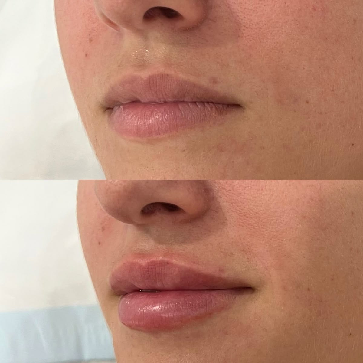 extreme lip plumper