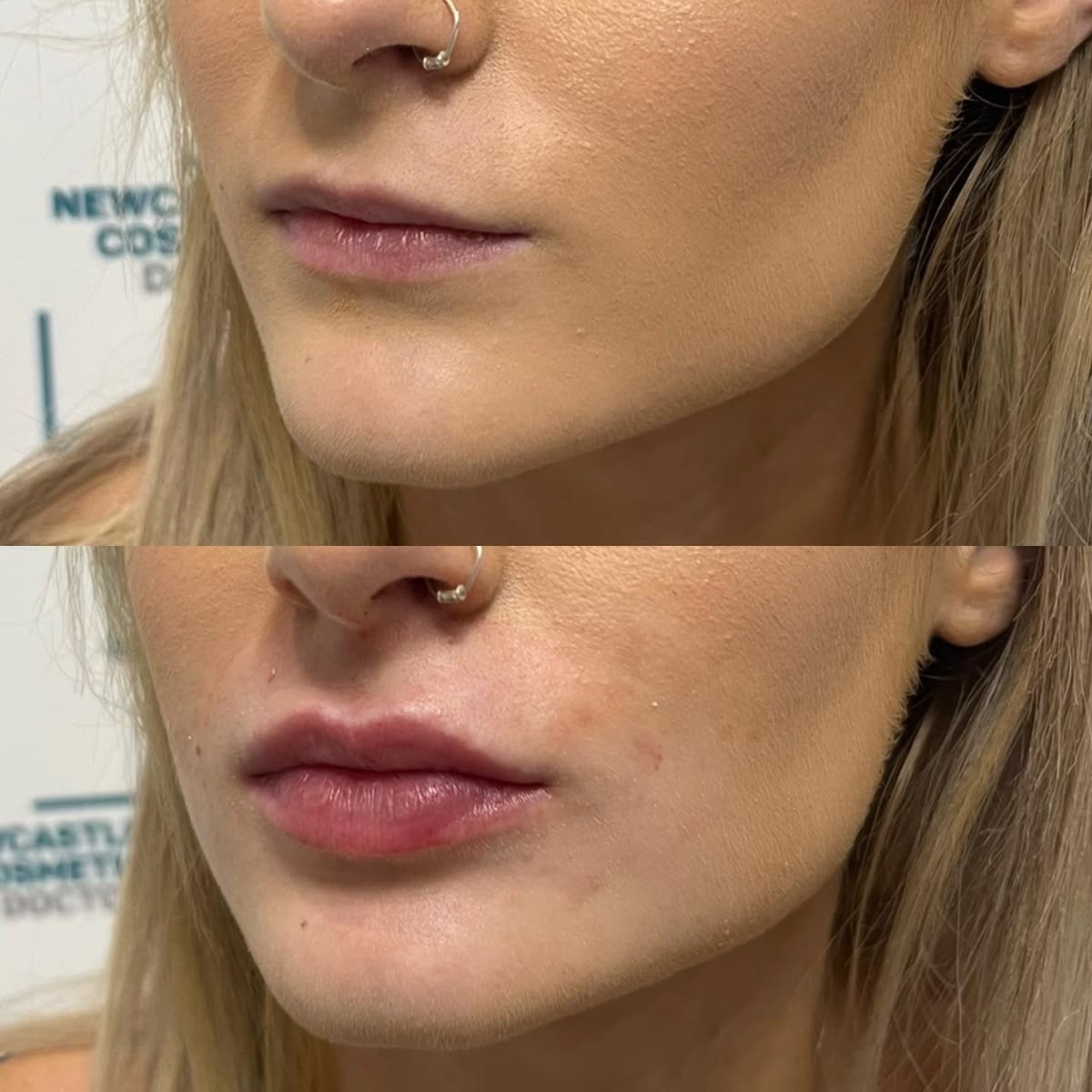extreme lip plumper