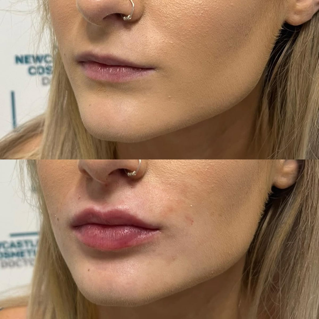 extreme lip plumper