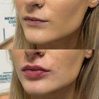 lip plumper