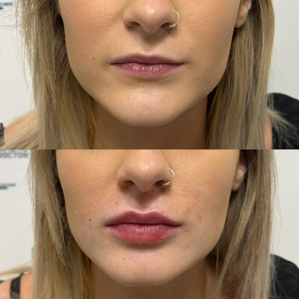 extreme lip plumper